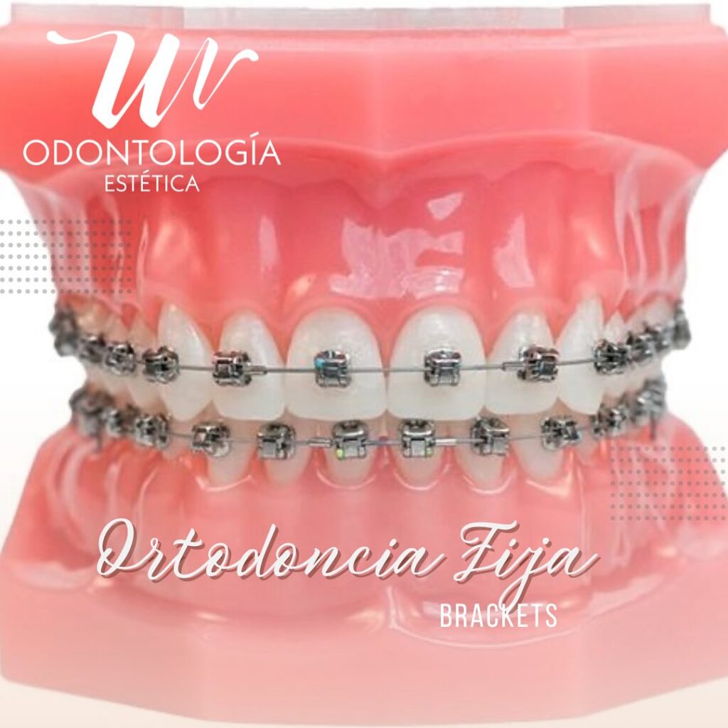 Ortodoncia Fija