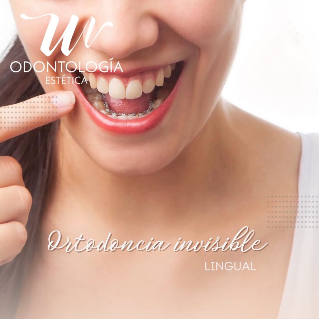 Alineadores Invisibles