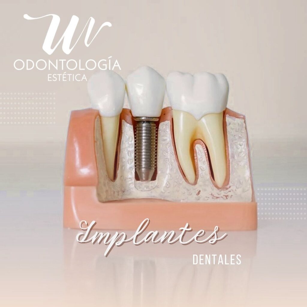 Implantes Dntales