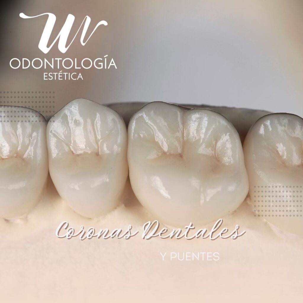 Coronas Dentales